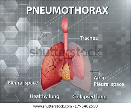 Informative illustration of Pneumothorax illustration