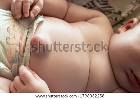 Umbilical hernia on a 8 week old baby boy   Royalty-Free Stock Photo #1796032258