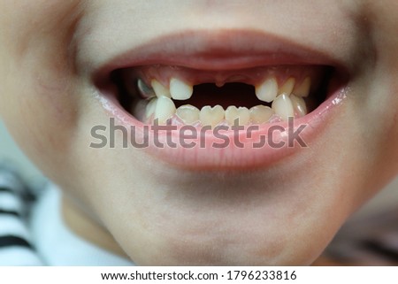 Close up child's mouth with missing upper front milk teeth, selective focus.