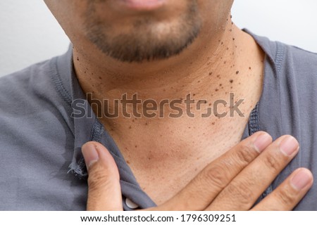 Closed up the Skin Tags or Acrochordon on neck man on white background. Health care concept