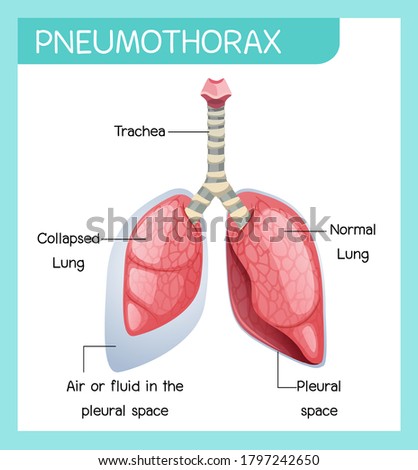 Pneumothorax cartoon of human anatomy illustration