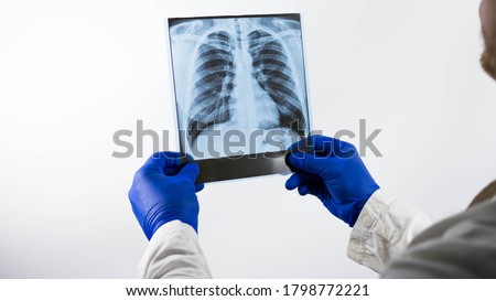 X-ray of the lungs at a doctor in a white coat in his hands on a white background,to make a conclusion to make a diagnosis on an X-ray picture,pulmonary pneumonia,edema.