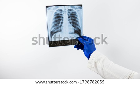 X-ray of human lungs on a white background in the hands of a doctor,X-ray diffraction,demonstration of the lungs in the picture,the patient is diagnosed with pulmonary edema,close-up.