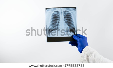 X-ray of human lungs on a white background in the hands of a doctor.Pneumonia of the lungs, infection,a medical professional is engaged in x-ray diffraction,diagnoses and concludes the patient. Royalty-Free Stock Photo #1798833733