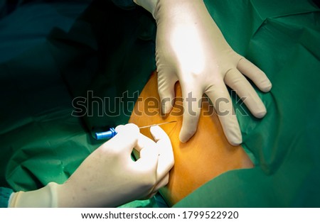 Spinal anesthesia injections,Epidural anesthesia injections in preparation for a caesarean section, Anesthesiologist or doctor prepping area where her is going to do a Epidural nerve or spinal block. Royalty-Free Stock Photo #1799522920