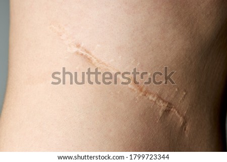 surgery scar after kidney pyelonephritis. after remove kidney operation. caucasian person close up over gray background. Royalty-Free Stock Photo #1799723344