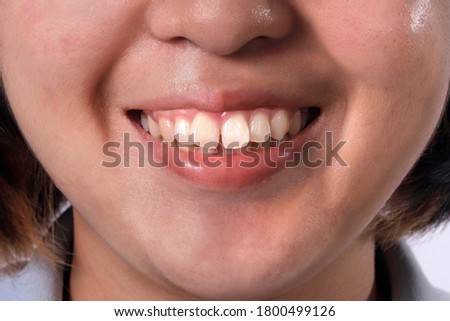 Close up Asian woman smiling shaped teeth make it look unattractive or bad teeth. Royalty-Free Stock Photo #1800499126