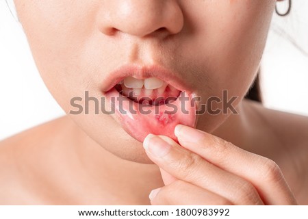 Asian woman have aphthous ulcers on mouth on white background, selective focus. Royalty-Free Stock Photo #1800983992