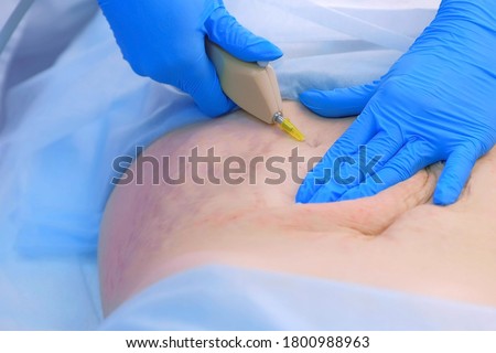 Doctor making injection of carbon dioxide on patient abdomen on carboxytherapy, tummy closeup.  