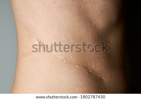surgery scar after kidney pyelonephritis. after remove kidney operation. caucasian person close up over gray background. Royalty-Free Stock Photo #1802787430