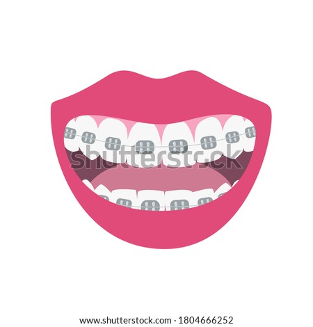 Happy smiles showing alignment and whitening teeth process. Alignment of bite of teeth, dental row  with braces, Orthodontic healthcare  concept. Vector illustration