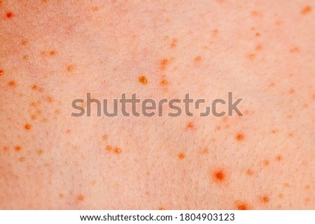 Close up image of a little boy's body suffering severe urticaria, nettle rash also called hives.