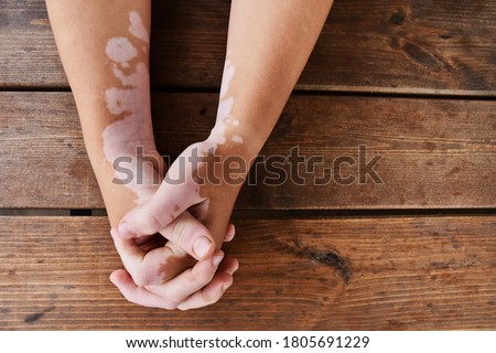 Woman holding hands together on a wooden background. she has skin disorder called vitiligo - white patches caused by loss of pigmentation. Royalty-Free Stock Photo #1805691229