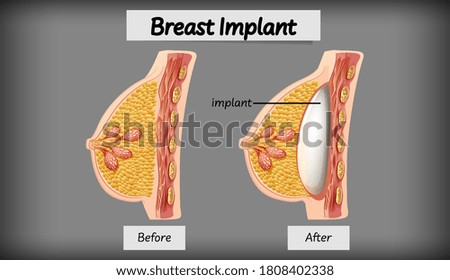 Anatomy of human breast implant illustration