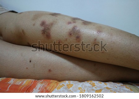 Close-up picture skin lesion legs sick woman disease atopic dermatitis real body medical concept skin treatment