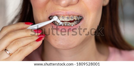 braces system in smiling mouth, macro photo teeth, close-up lips, macro shot.