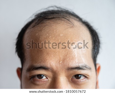 Closed portrait of Asian man forehead with sweating on his forehead cause of hot weather or etc. Sweat is actually the body's built-in cooling system when your body temperature rises. Royalty-Free Stock Photo #1810057672