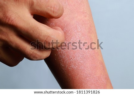 Man scratch the itch with hand, elbow itching, allergic rash dermatitis eczema skin of patient hand. Royalty-Free Stock Photo #1811391826