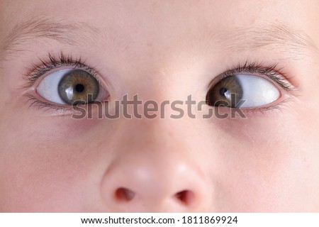 Child's face with squint and freckles on nose. Strabismus in children causes and treatment concept Royalty-Free Stock Photo #1811869924