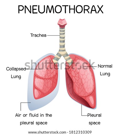 Pneumothorax cartoon of human anatomy illustration
