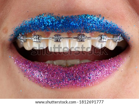 smile of a girl with braces on a white background