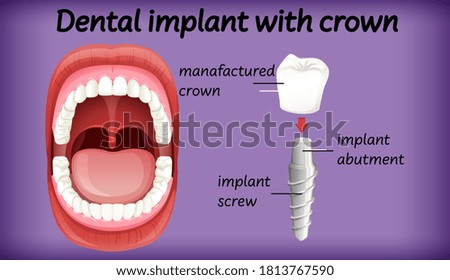 Dental implant with crown illustration