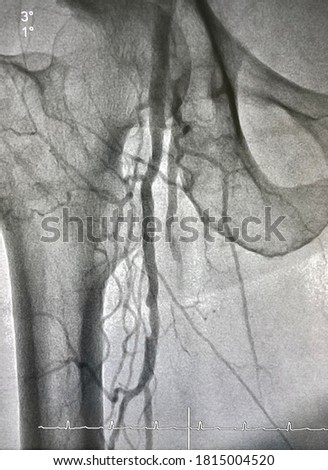 Right femoral artery angiogram at cardiac catheterization room. Royalty-Free Stock Photo #1815004520