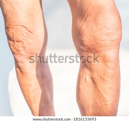 Poor knee joints of the elderly with muscular inflammation and osteoarthritis. Royalty-Free Stock Photo #1816133693
