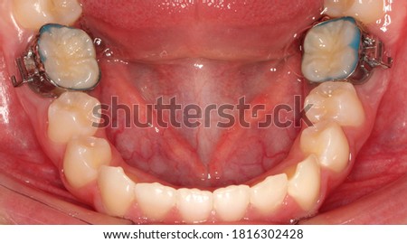 orthodontic bands in lower molars Royalty-Free Stock Photo #1816302428