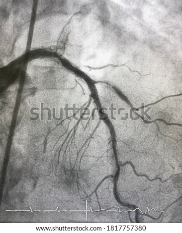 Coronary angiogram shown in stent restenosis (ISR) at left main to left anterior descending artery (LAD) and left circumflex artery (LCx). Royalty-Free Stock Photo #1817757380