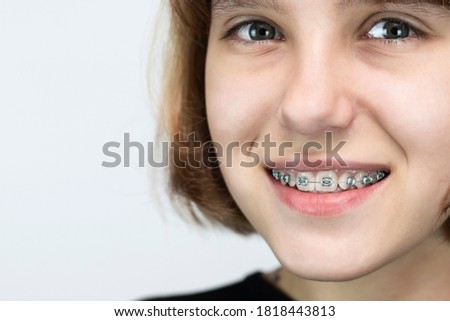 Close-up portrait of a young girl smiling, clearly visible braces with blue rubber bands on her teeth. Copy space. Dental concept