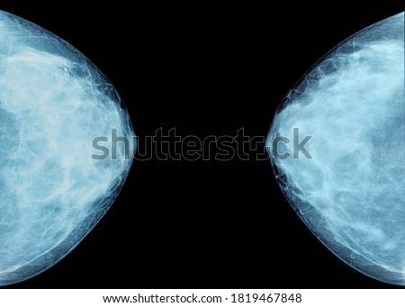 X-ray mammography cancer checking breasts scan