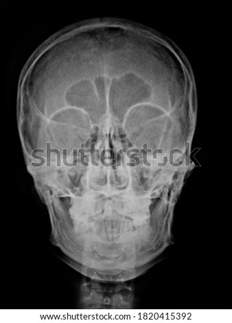 Film x-ray of normal human skull 