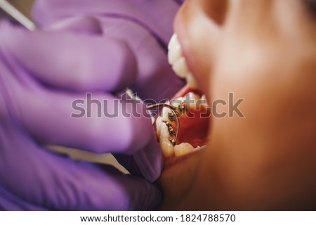 Cropped shot of a beautiful young woman is at the dentist. She sits in the dentist's chair and the dentist sets braces on her teeth putting aesthetic self-aligning lingual locks. Royalty-Free Stock Photo #1824788570