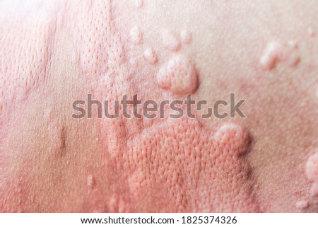 urticaria on skin. rashes, of which urticaria and toxic erythema are the most common. Royalty-Free Stock Photo #1825374326