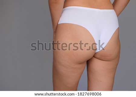 Thick with cellulite thighs and buttocks of a young woman