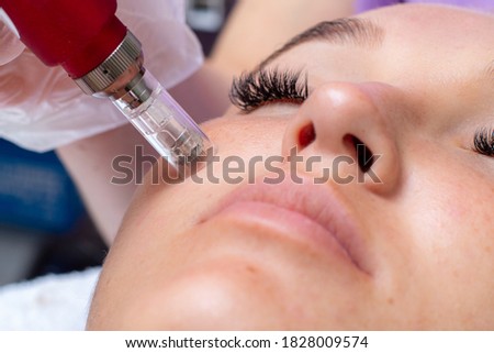 Fractional microneedle facial therapy close up Royalty-Free Stock Photo #1828009574