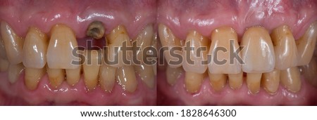 Replacing missing tooth with dental implant, implant supported crown, before and after. Royalty-Free Stock Photo #1828646300