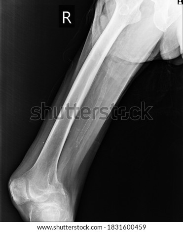 plain radiography of right femur and calcified vessel right femural vein Royalty-Free Stock Photo #1831600459