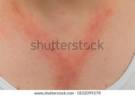 A white lady with allergic contact dermatitis red rash on chest and neck from reaction to nickel jewellery necklace Royalty-Free Stock Photo #1832099278
