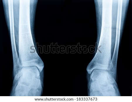Xray of a human ankle isolated