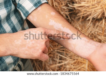 A man with vitiligo shows a finger to the spots on the skin.