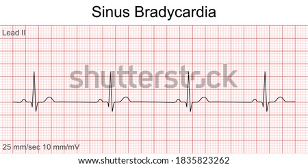 Electrocardiogram show Sinus bradycardia pattern. Cardiac fibrillation. Heart beat. CPR. ECG. EKG. Vital sign. Life support. Defib. Emergency. Medical healthcare symbol. Royalty-Free Stock Photo #1835823262