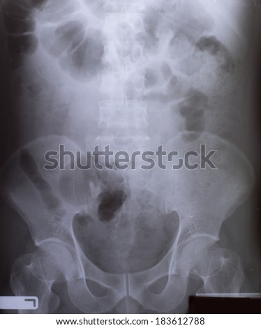 X-Ray Image Of Human for a medical diagnosis