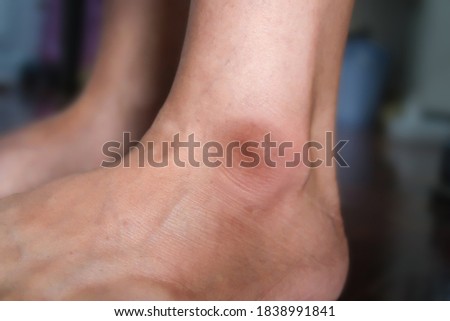 Ankle cyst has a swollen lump close up