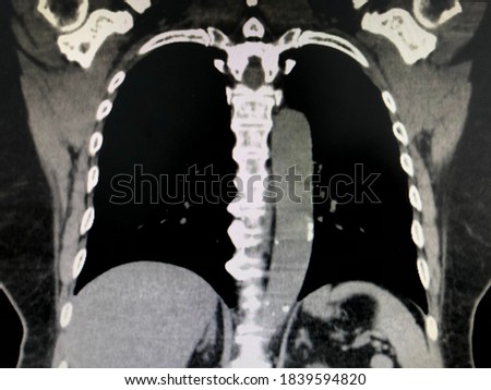 Computed tomography angiography (CTA) of Aorta and lungs Royalty-Free Stock Photo #1839594820