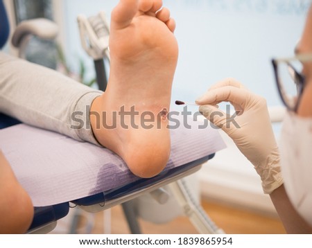 Podiatrist treating a wart verrucas plantar on a patient's foot, no faces shown Royalty-Free Stock Photo #1839865954