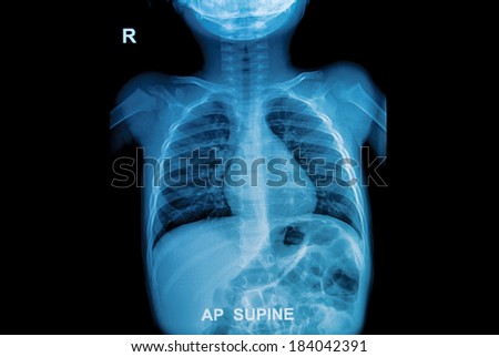 Chest  x-ray of children