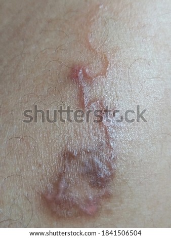 Cutaneous Larva Migrans Stock Photos And Images Avopix Com