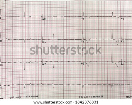 COMPLETE-HEART-BLOCK Stock Photos and Images - Avopix.com